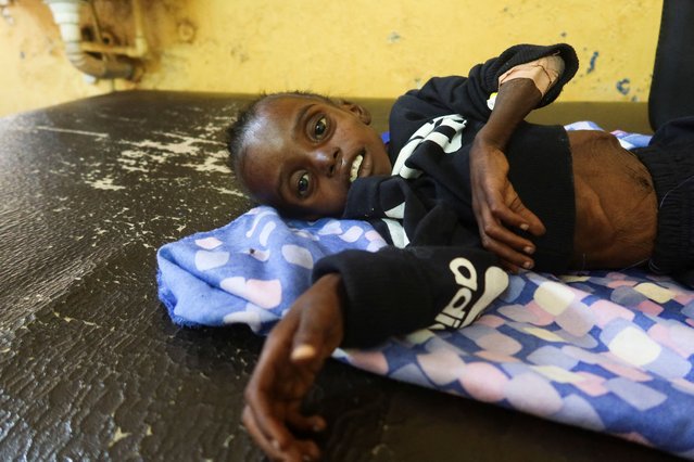 A child suffering from malnutrition reacts while lying on a bed in Alban Jadeed hospital, as young children struggling with malnutrition fill wards in the Sharg Elnil area, in Khartoum, Sudan on March 15, 2025. (Photo by El Tayeb Siddig/Reuters)