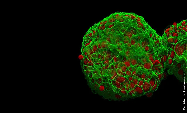 A three dimensional view of a cell culture of breast cancer cells, by Dr. Jonatas Bussador do Amaral and Dr. Gláucia Maria Machado Santelli of the University of São Paulo in São Paulo, Brazil