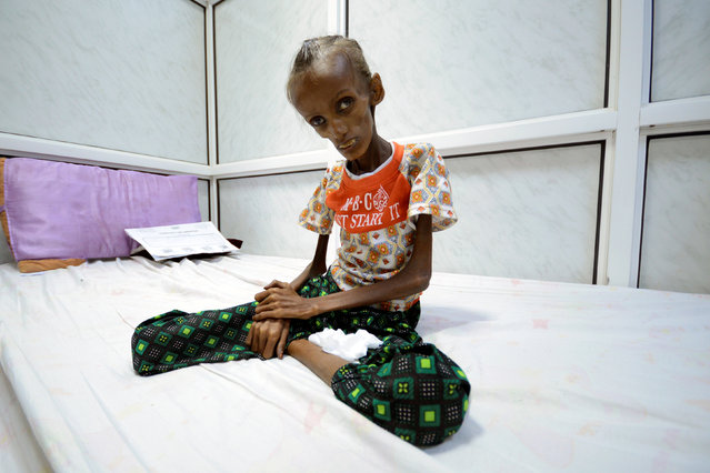 Saida Ahmad Baghili, 18, who is affected by severe acute malnutrition, sits on a bed at the al-Thawra hospital in the Red Sea port city of Houdieda, Yemen October 24, 2016. (Photo by Abduljabbar Zeyad/Reuters)