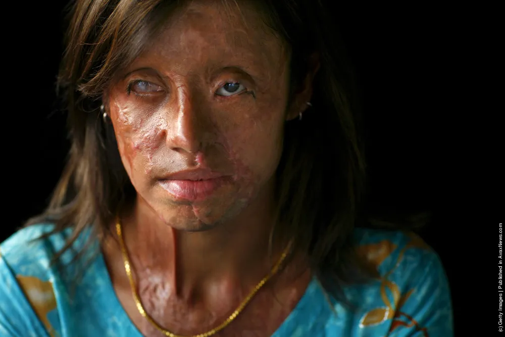 Acid Attack Plastic Surgeon Honoured With Oscar Nomination