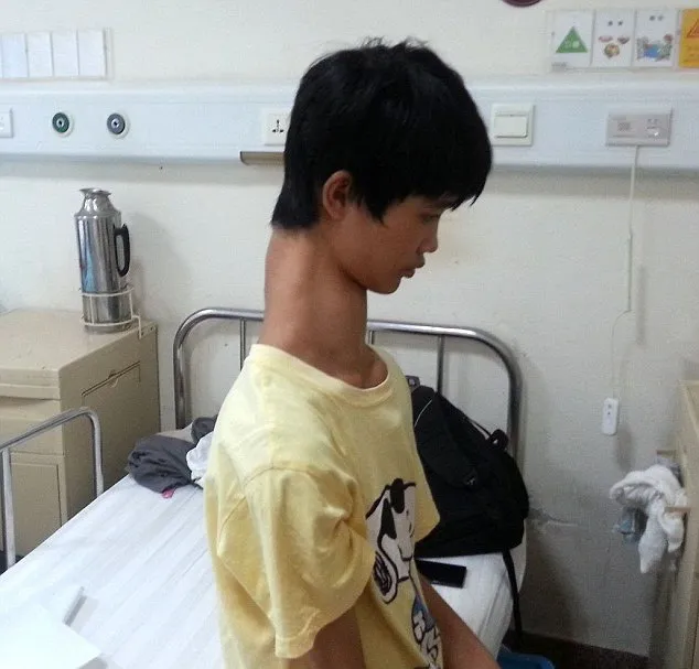 Chinese Teenager With Unusually Long Neck