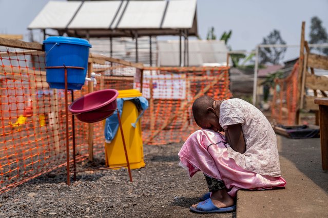 A young girl suffering from mpox waits for treatment at a clinic in Munigi, eastern Congo, Friday, August 16, 2024. (Photo by Moses Sawasawa/AP Photo)