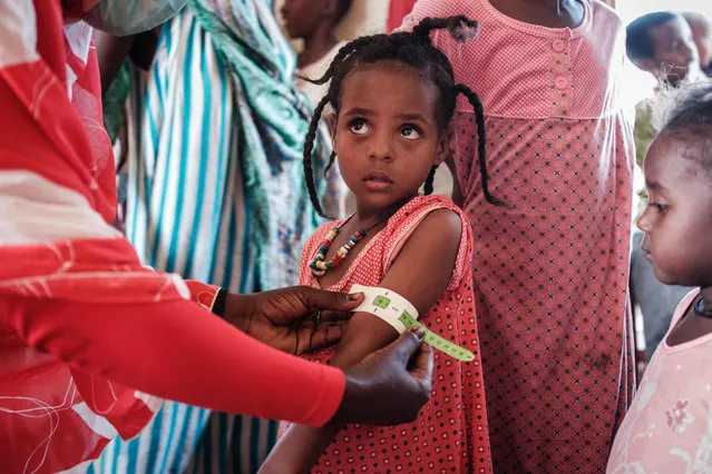 A four-year-old Ethiopian girl who fled the Tigray conflict as a refugee is measured at a malnutrition center at Village Eight transit centre near the Ethiopian border in Gedaref, eastern Sudan, on December 2, 2020. (Photo by Yasuyoshi Chiba/AFP Photo)