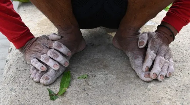 A worker shows his swollen hands and feet after working in the water for hours while harvesting water spinach (locally known as Kangkong) in Laguna lake, suburban Manila on August 18, 2023. (Photo by Ted Aljibe/AFP Photo)