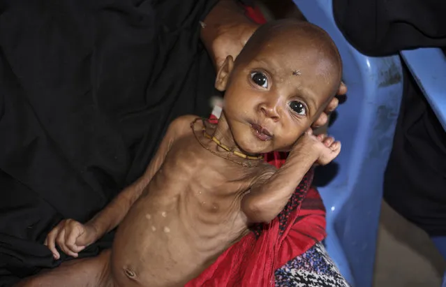 In this photo taken Saturday, February 25, 2017, malnourished baby Ali Hassan, 9-months-old,  is held by his mother Fadumo Abdi Ibrahim, who fled the drought in southern Somalia, at a feeding center in a camp in Mogadishu, Somalia. Thousands of desperate people are streaming into Somalia's capital seeking food as a result a prolonged drought, overwhelming local and international aid agencies, while the Somali government warns of a looming famine, compounded by the country's ongoing conflict against Islamic extremists. (Photo by Farah Abdi Warsameh/AP Photo)