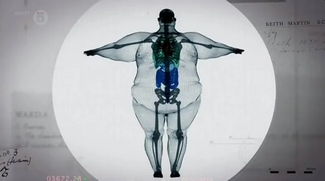 This is the shocking image which claims to be an x-ray of a 64-stone man. The picture, which has gone viral on Twitter, appears to show a hugely obese man standing with his hands out to either side. Although captioned as an “x-ray of 900lb man”, many have suggested it looks more like a 3D model – others have suggested it could be a fake. (Photo by Twitter)