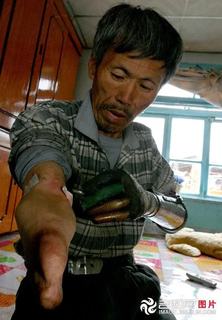 Farmer Builds Own Bionic Arms