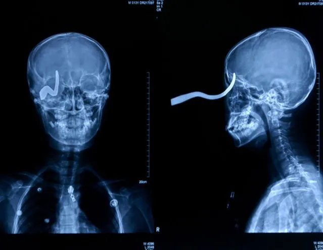 2mm from death: A 13-year-old slipped on an icy school floor in China after a faulty heater had leaked overnight. Xiao Lin fell forward onto a hook which embedded in his eye. A school handyman sawed the hook off the wall to free the lad, leaving 5cm sticking out of his head. Surgeon Yan Shijun commented: “The hook pierced his skull but was turned to the side by the impact. (Photo by Rex Features)