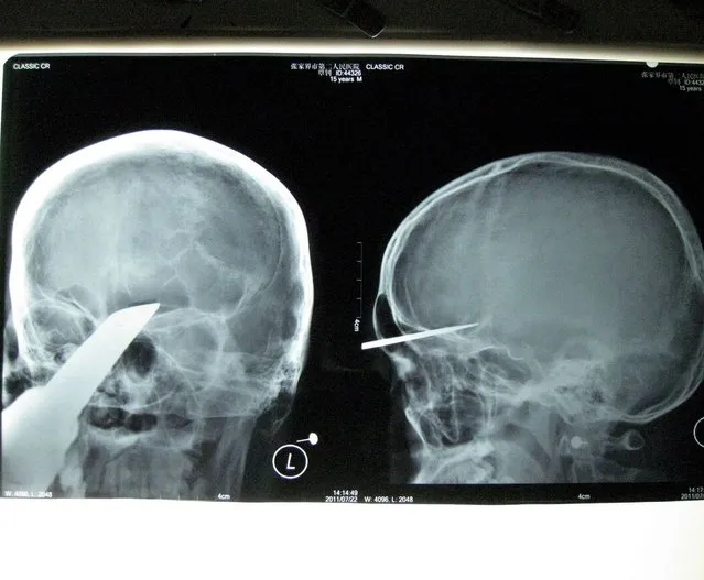 Sword survivor: Obviously you'd take a sword with you when you go round to visit your mate... Zhang Bin, 15, was taken 400km to hospital with 5cm of a 50cm sword embedded in his head. He said later: “Three classmates came to visit me at home and one of them brought a sword. He stood 3-4m away from me. I don't know how the sword could fly to me and stab into my head. I felt sharp pains and a large amount of blood streamed down”. (Photo by Rex Features)