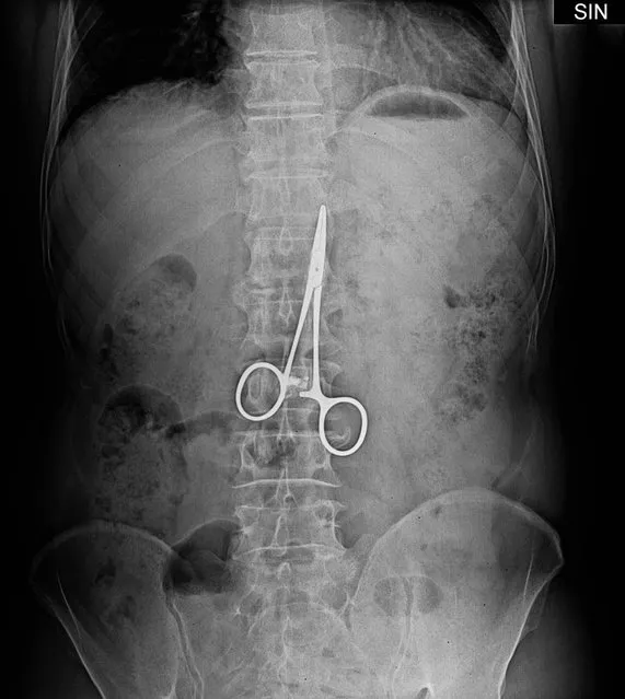 An unwanted souvenir: A man who went to hospital with stomach pains was found to have a surgical clamp inside his belly – from an operation 37 years before. Liu Mou, from China, had gastric ulcer surgery in 1974 and had frequently suffered stomach pains in subsequent years. He comments: “I thought it was my old stomach problems and each time I took stomach medication or anti-inflammation pills to relieve the pain”. (Photo by Rex Features)