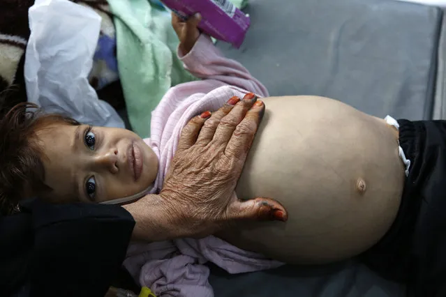 A malnourished child lies on the bed, waiting for the doctor to treat her, at the malnutrition treatment department of a hospital in Sanaa, Yemen on July 16, 2022. (Photo by Xinhua News Agency/Rex Features/Shutterstock)