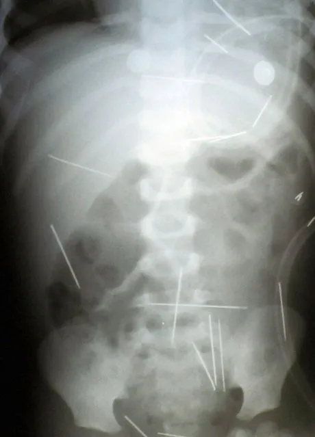 Not so much needle in a haystack... A two-year-old boy taken to hospital in a remote Salvador town was found to have dozens of needles in his body. Doctors discovered 42 metal needles, two of them dangerously close to his heart. Police feared the needles had been used in an occult ceremony. A Brazilian man and two women were arrested. (Photo by Rex Features)