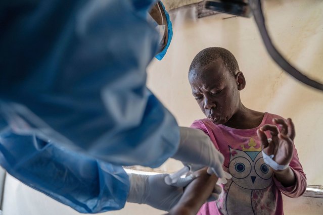 A health worker attends to a mpox patient at a treatment center in Monigi, Congo, on Monday, August 19, 2024. The Democratic Republic of Congo is at the epicenter of an mpox outbreak declared a global health emergency last week by the World Health Organization. African nations could begin vaccinations against mpox within days, according to the continent’s top public health agency. (Photo by Moses Sawasawa/AP Photo)
