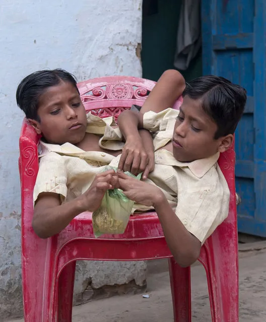 Conjoined Twins Who Are Worshipped In India