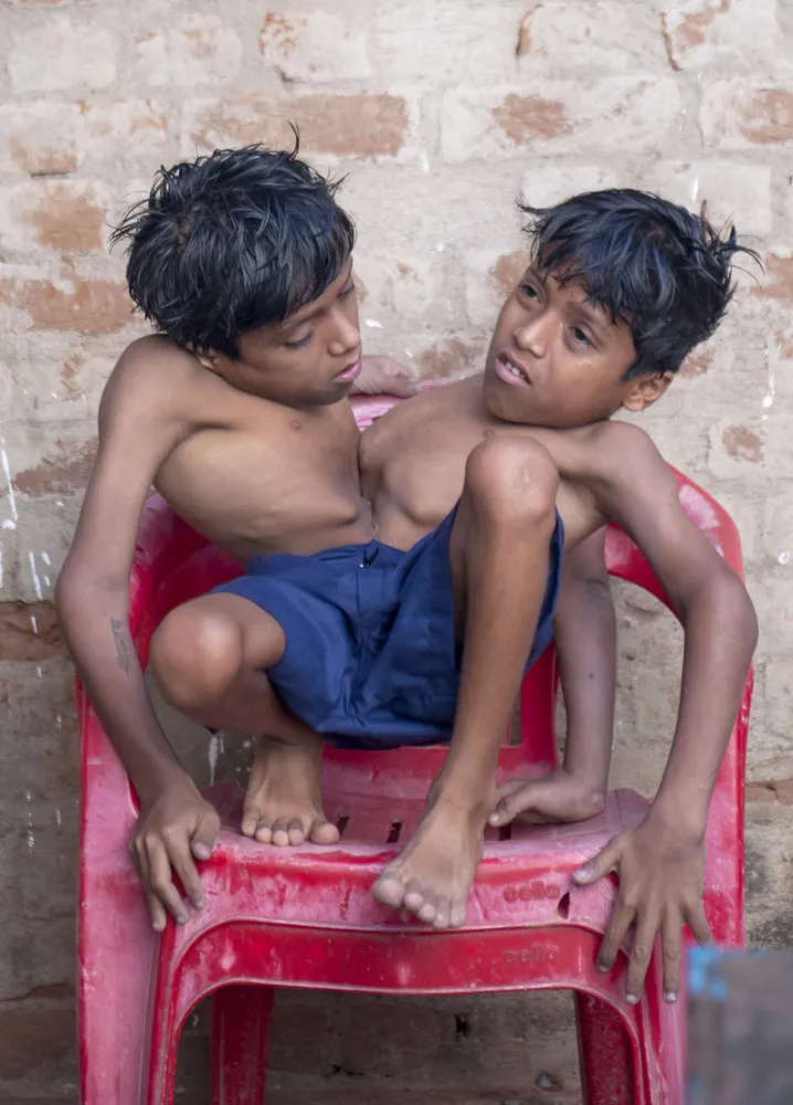 Conjoined Twins who are Worshipped in India