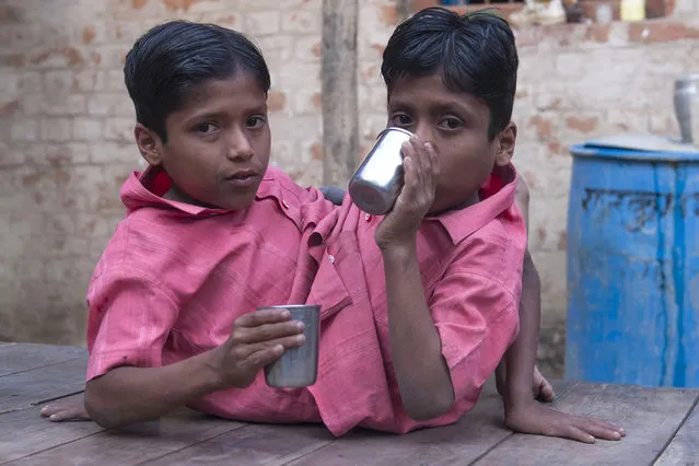 Conjoined Twins Who Are Worshipped In India