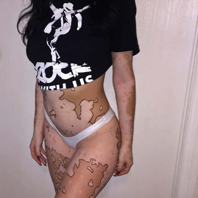 A bullied student with vitiligo is celebrating learning to love her skin by turning it into art  making a world map, flowers and even a Van Gogh painting. Ashley Soto, 21, from Orlando in Florida, USA, has found turning her white patches of skin into art has empowered her and helped her to embrace her vitiligo. She was diagnosed with the condition that affects one percent of the worlds population, at the age of 12 when a porcelain spot appeared on her neck. Within a year, it had spread to 75% of her body in spots and patches. After being asked if she had showered in bleach the teen hid her skin beneath long jumpers and jeans to avoid further ridicule. But now, shes turning her body into art by tracing her vitiligo, making a world map and a beautiful arrangement of flowers to Vincent van Goghs The Starry Night painting. The designs can take up to three hours to paint and outline the melanin-free areas of her body, helping her to appreciate the beauty in her vitiligo. Here are some of the art pieces Ashleys made to celebrate and embrace her vitiligo from a world map to simply tracing her vitiligo and also Van Goghs Starry Night. (Photo by Ashley Soto/Caters News Agency)