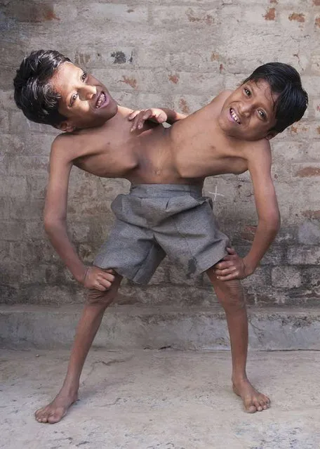 Conjoined Twins Who Are Worshipped In India