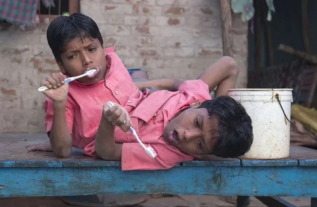 Conjoined Twins Who Are Worshipped In India