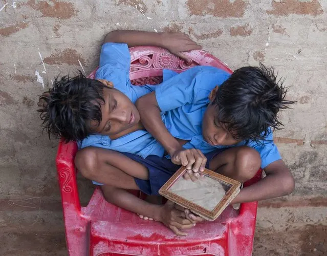 Conjoined Twins Who Are Worshipped In India