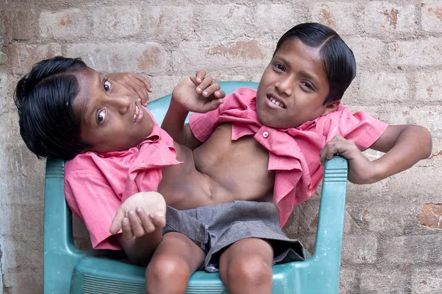 Conjoined Twins Who Are Worshipped In India