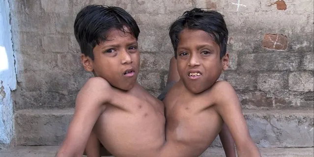 Conjoined Twins Who Are Worshipped In India