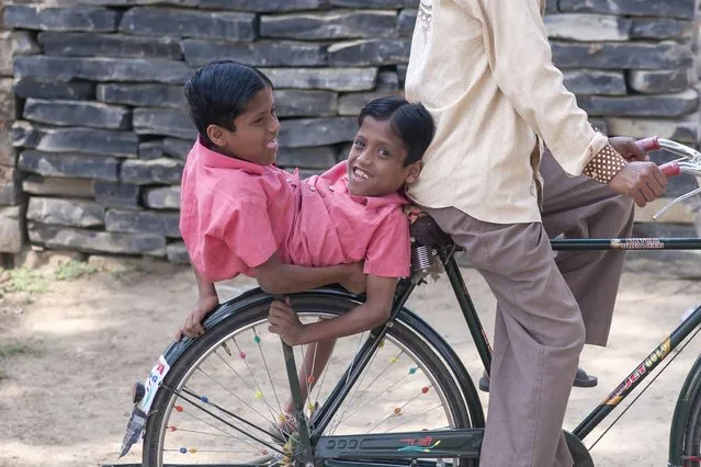 Conjoined Twins Who Are Worshipped In India