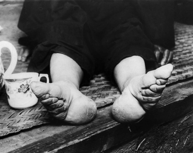 The national government at Nanking is now trying to stamp out “bound feet” which has caused women and children misery for a great number of years. Chinese women attempt to make their feet smaller by binding them in childhood. This is a September 21, 1936 photo. (Photo by AP Photo)