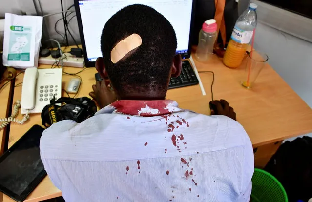 Paul Murungi, a journalist working with The New Vision newspaper is seen at their offices after he was injured following an attack by security officials, outside the United Nations Human Rights offices while on reporting duty, in Kampala, Uganda on February 17, 2021. (Photo by Abubaker Lubowa/Reuters)