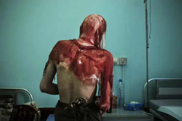 Monir al-Sharqi walks to his bed after nurses changed the dressings on his burns, at the Marib General Hospital in Yemen on July 25, 2018. Al-Sharqi, a lab technician, disappeared for a year, until he was dumped in a stream, half-naked, emaciated and bearing horrific marks of torture. He had burns from acid over his head, back and shoulders, so severe that his jacket stuck to his melted skin. Some members of his family believe he was detained and tortured by Yemen's Houthi rebels because of his past political activism. (Photo by Nariman El-Mofty/AP Photo)