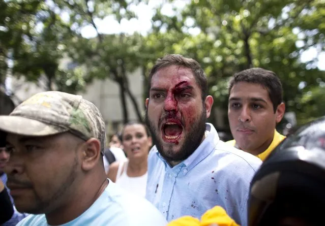 Opposition lawmaker Juan Requesens, center, is escorted by his colleague Jose Manuel Olivares, right, after begin injured by alleged pro government supporters as they protest outside of the Ombudsman's offices in Caracas, Venezuela, Monday, April 3, 2017. A group of opposition lawmakers was attacked by suspected followers of the Government during a demonstration in the center of the capital that left at least one injured Congressman. (Photo by Ariana Cubillos/AP Photo)