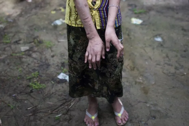 San Kay Khine, a 17-year-old Myanmar child slave, shows her scarred arms and twisted fingers while recovering in her family's village in Baw Lone Kwin in Kawmu township located outside Yangon on September 20, 2016. Scarred by burns and stabbings with scissors, her twisted fingers an ever present reminder of the five years she spent as a child slave in Yangon. A Myanmar couple who runs a tailoring shop employed San Say Khine and  Thazin, 16 year old, in Yangon where the two minors were physically abused while working as a helper. (Photo by Ye Aung Thu/AFP Photo)