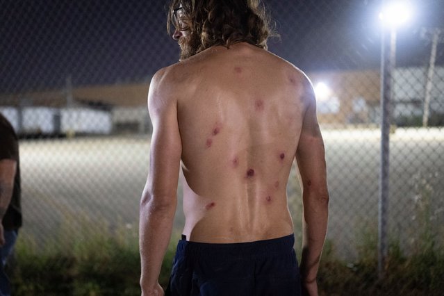 The back of a demonstrator is pock-marked with wounds after federal law enforcement agents opened fire with pepper balls while he was protesting outside of an immigration processing center on September 22, 2025 in Broadview, Illinois. Demonstrators have been maintaining a presence outside of the facility, protesting a recent surge in ICE activity in the Chicago area dubbed Operation Midway Blitz by the Trump Administration. (Photo by Scott Olson/Getty Images)